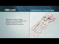 Keel-Lock™ Nitinol Implant System Animation