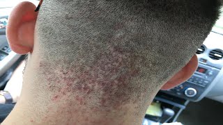 how to get rid of acne on back of head