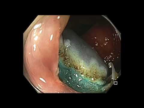 Colonoscopy: Transverse Colon EMR - SSA