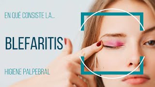 Blefaritis