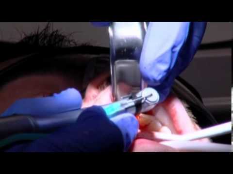 Stem cells to allow growing new teeth. Video