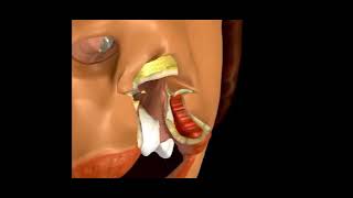 Rotation Advancement Cleft Lip Repair