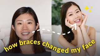 How Braces Changed My Face in 1 Year | My Invisalign Journey