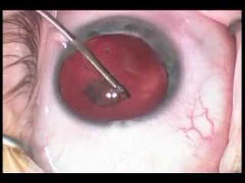 Cataract Surgery For Posterior Lenticonus 