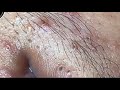 Blackhead Removal