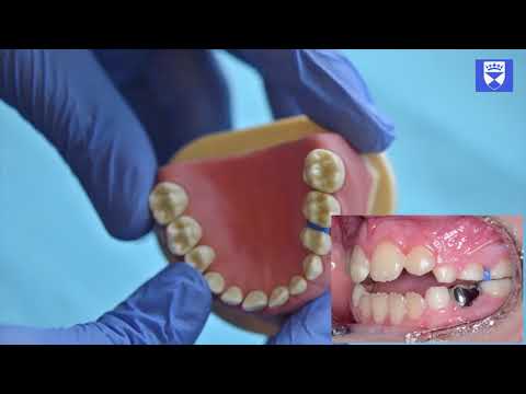 Technika założenia i usunięcia separatora ortodontycznego