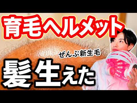 【4ヶ月検証】赤色LEDで髪生えました【育毛ヘルメット】
