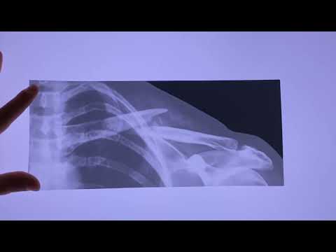 Slide 2 - Broken Bones X-Rays, 15 Pieces (video)