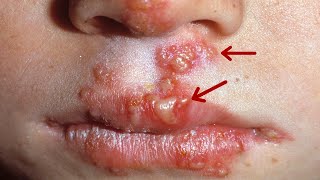 How to Get Rid of Cold Sores in Nose - Top 10 Best Home Remedies for Cold Sores in Nose
