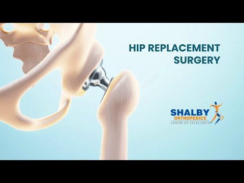 Hip Replacement Surgery FAQs
