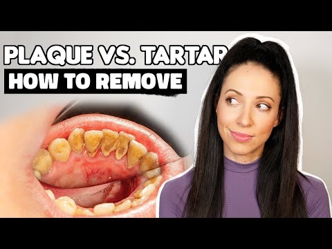 Plaque vs. Tartar | How To Remove Plaque From Teeth