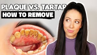 Plaque vs. Tartar | How To Remove Plaque From Teeth