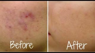 How To Get Rid of Acne FAST! (Guaranteed Clearer Skin)