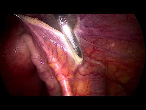 marSeal5 – Anwendungen in der GYN (Teil 1)