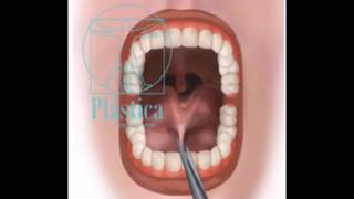 Frenillectomia lingual - Procedimiento Oral - Dra. Sandra Nieto