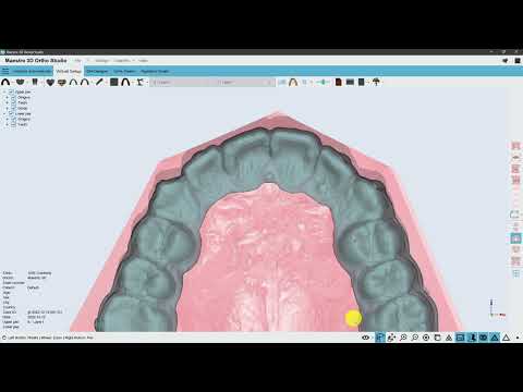 Directly 3D Printed Clear Aligners