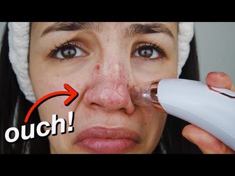 PORE + BLACKHEAD REMOVER VACUUM! *UP CLOSE FOOTAGE*