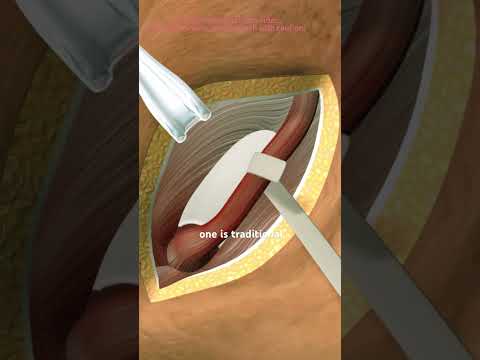 Inguinal Hernia Repair Surgery (3D Animation) #epicmusicword #3danimation #epic #facts #3dmodeling