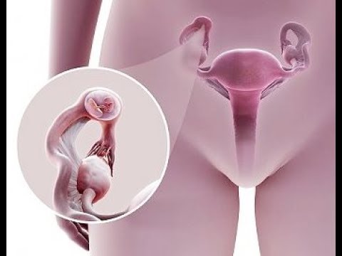 Отложение солей в суставах лечение листьями хрена Сделать мрт коленного сустава в красноярске