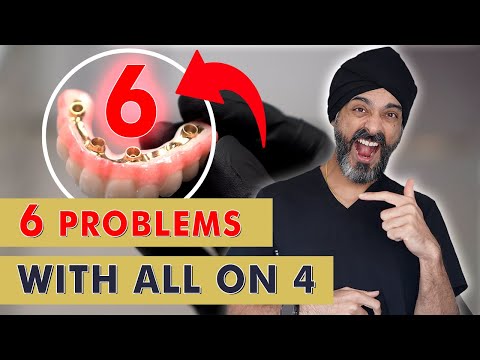 6 Things your Dentist May NOT tell you about All on 4 or a Full Set of Dental Implants
