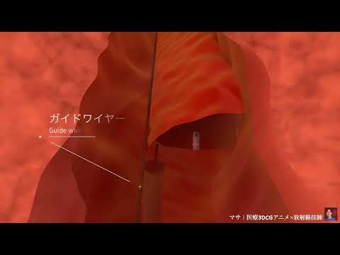 大動脈解離のステントグラフト治療