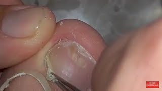 Cleaning my toenail. Dead skin and stuff.
