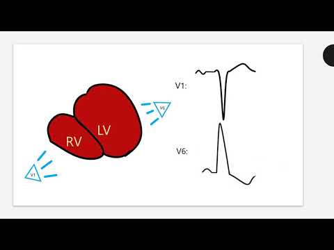 LVH on the ECG video