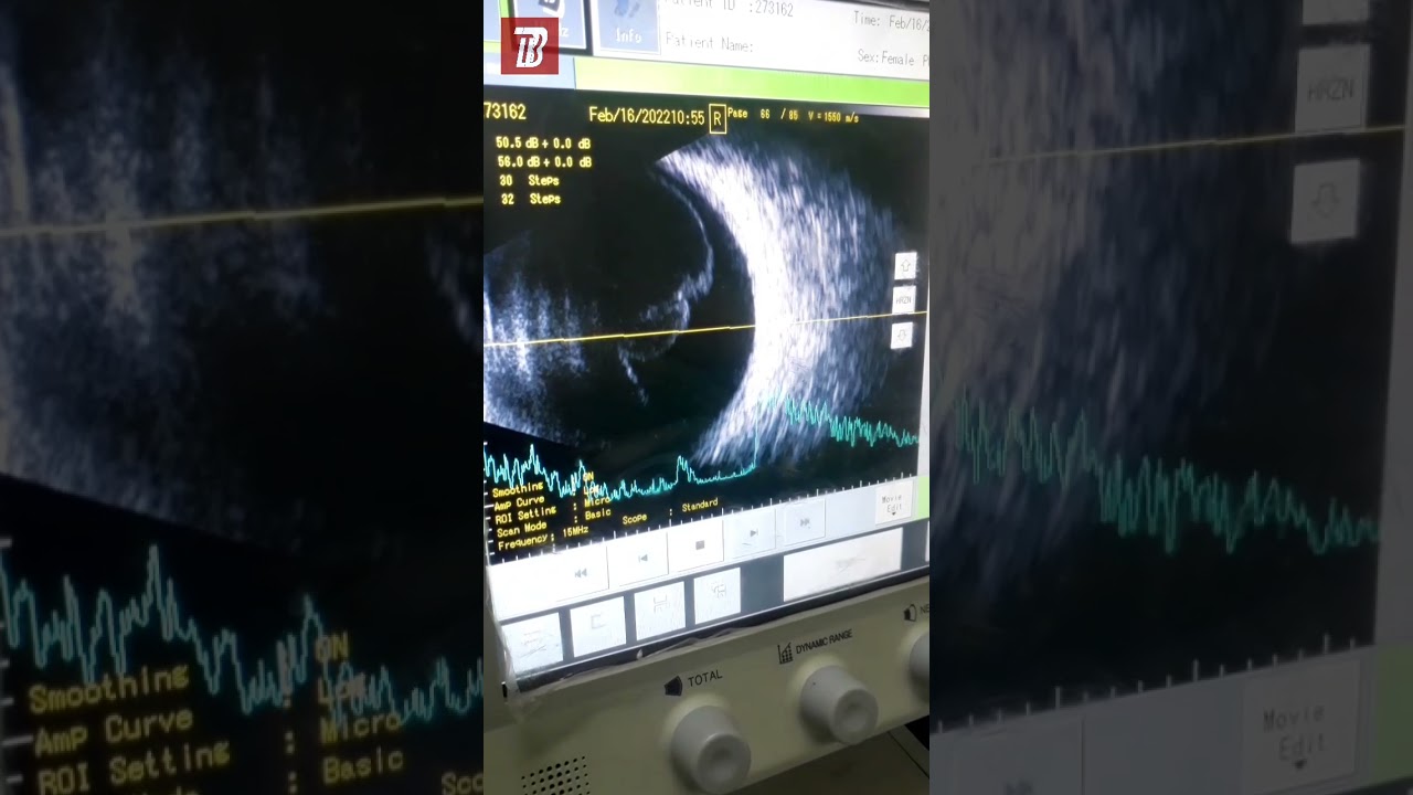 Eye Ultrasound / USG / Mata / Pemeriksaan Diagnostik