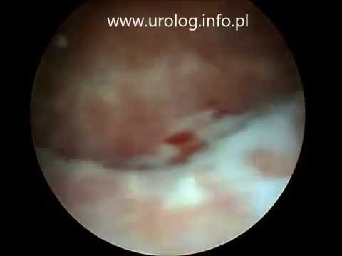 Cystoskopia - zmiany po RTG terapii