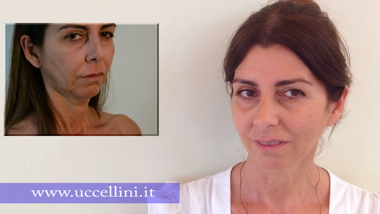 fili riassorbibili di sospensione e biostimolazione