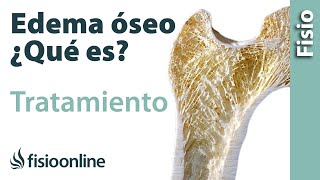 Edema óseo - Qué es, causas, síntomas y tratamiento