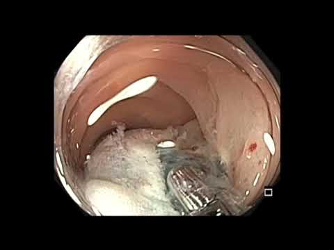 Colonoscopia - extirpación de un pólipo de sigmoide con el uso del gel Orise Gel