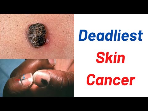 The deadliest skin cancer?