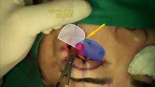 Short-Incision Midface-Lift Procedure
