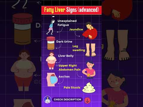 10 Warning Signs of Fatty Liver You Should Never Ignore! Fatty Liver Disease