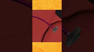 Fixing a Hole in Your Heart: PFO Closure Explained!🫀