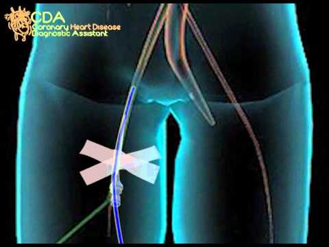 Diagnostische Koronarkatheterisierung