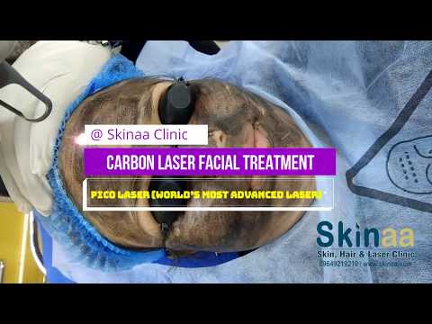 Carbon laser Facial & Peeling Treatment with Pico Laser at Skinaa Clinic, Jaipur