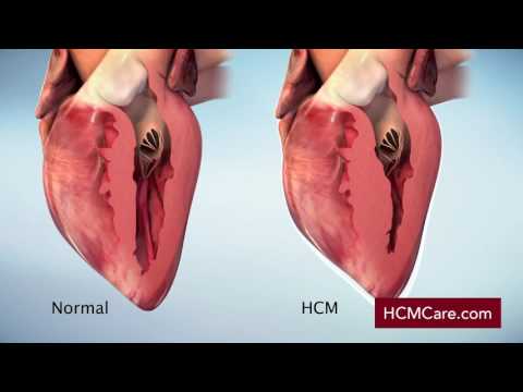 image-What is a normal Lvot?