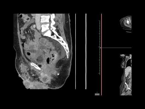 Carcinoma espinocelular da vulva localmente avançado - achados tomográficos.