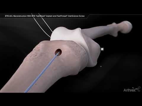 Btb acl reconstruction with btb tightrope implant and fastth...