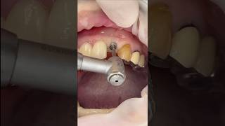임플란트 과정, 임플란트수술 한국인이 좋아하는 속도로 (Implant procedure, Implant surgery, 임플란트 식립, 임플란트 전 과정 종류와 기구까지)