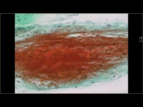 2024 08 10 Dr Lai cytology   glandular lesion