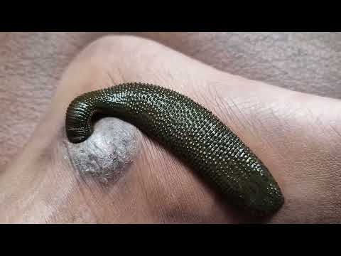 Leech therapy for Skin diseases । रक्तमोक्षण । जलौकावचरण । जळू | Leech