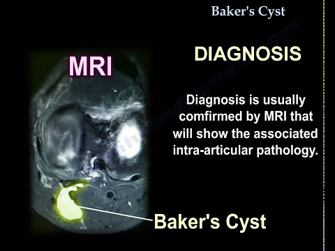 Baker-Zyste