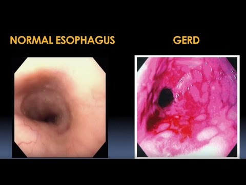 Diagnosis and Treatment for Esophageal and Motility Disorders Video - Brigham and Women's Hospital