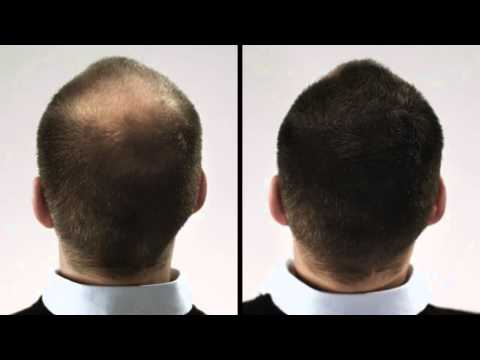 Haarstreu Streuhaar Haardicht - Hairmaker - Wie es funktioniert