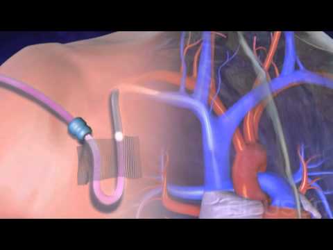 Central venious catheter CVC   peripherally inserted central catheter PICC medical animation
