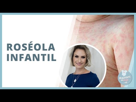 ROSÉOLA IN BABIES: SIGNS AND SYMPTOMS