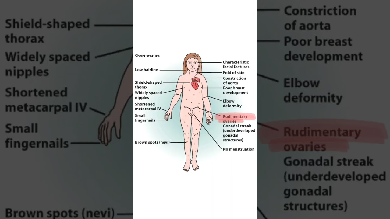 Turner's Syndrome | Chromosomal Disorder #shorts #neet #biology